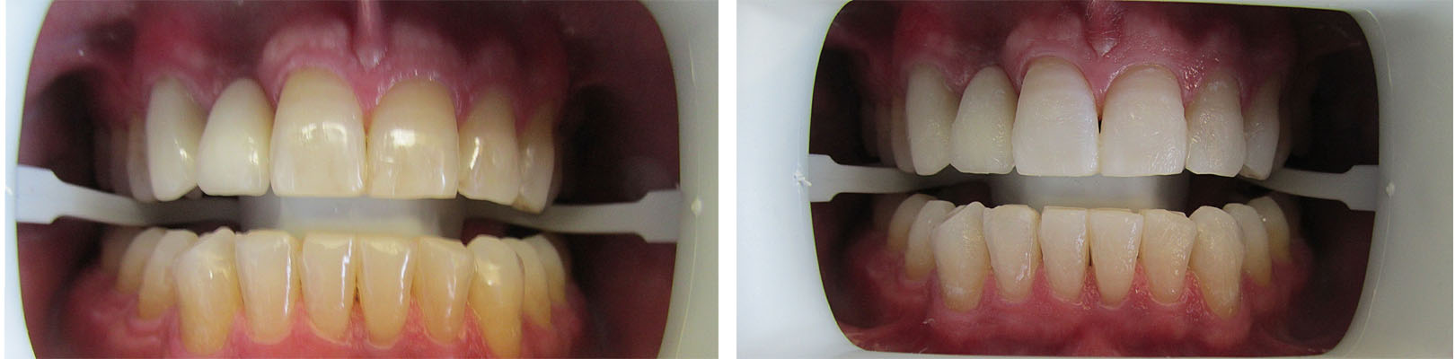 Before and After Dental Bleaching Photo