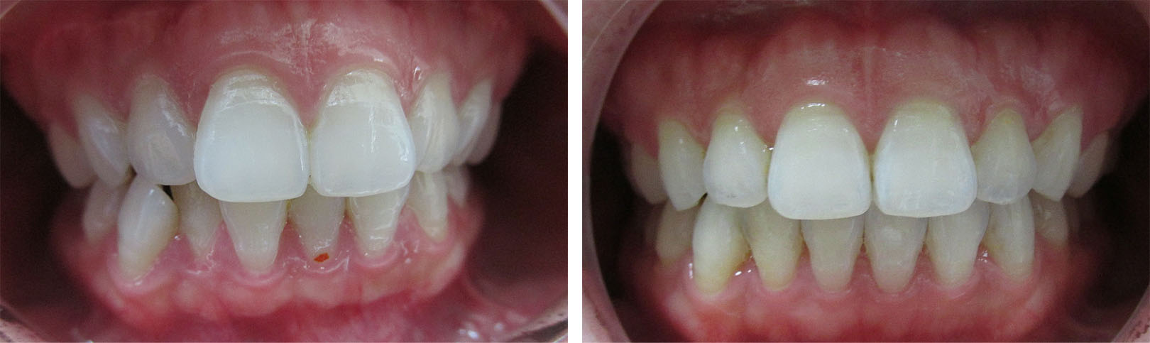 Before and After Invisalign Photo